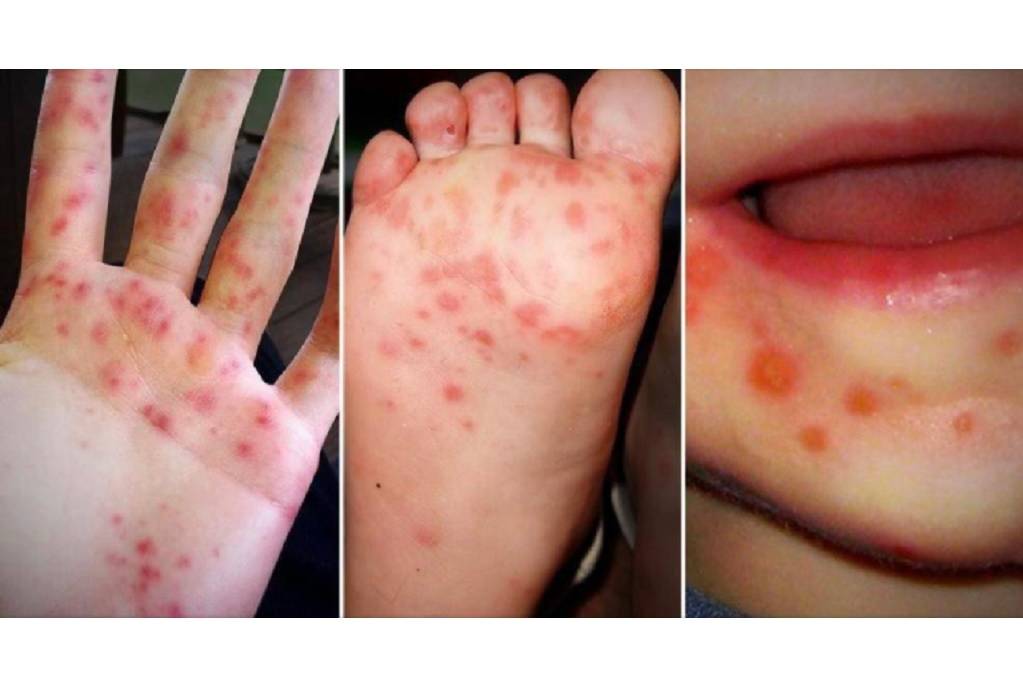 Increased reports of hand, foot, and mouth disease cases in SVG