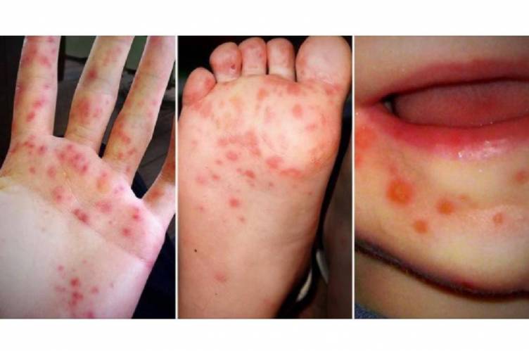 Increased reports of hand, foot, and mouth disease cases in SVG