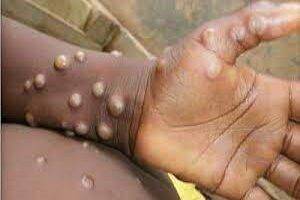 Trinidad takes precautions regarding monkeypox virus