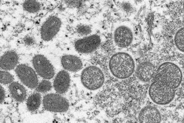 Second case of Monkeypox confirmed in Jamaica