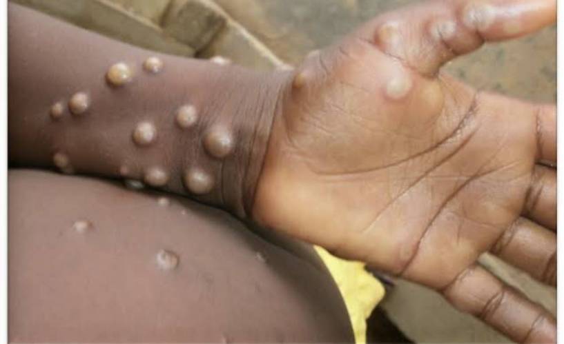 Local testing for monkeypox could be available within weeks