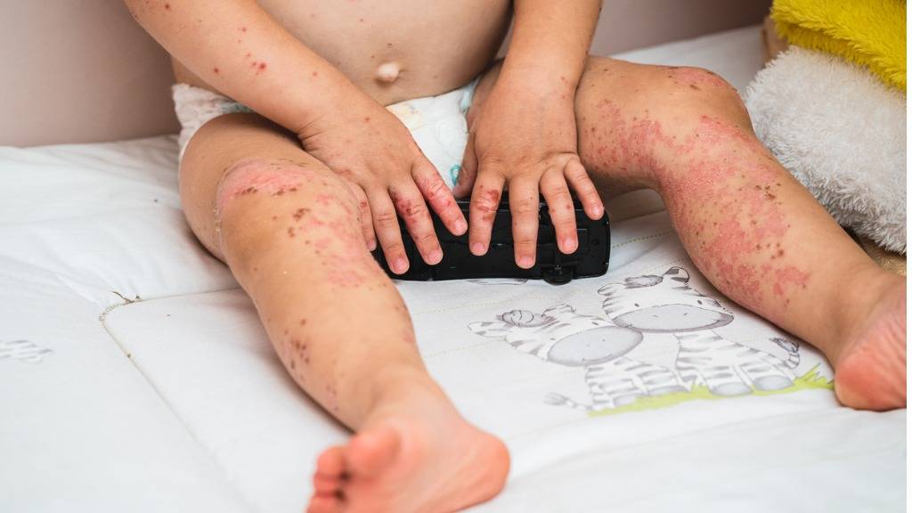 BVI investigates eight suspected cases of Hand Foot and Mouth Disease