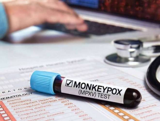 Jamaica: Man tests positive for COVID, monkeypox and HIV after Spain trip