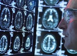 New Alzheimer's momentous breakthrough as drug slows cognitive decline by a quarter
